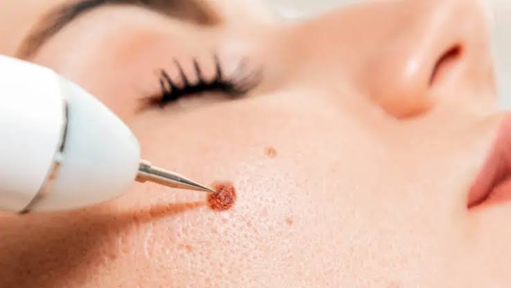 Minor Skin Lesion Excision - Velura Clinic